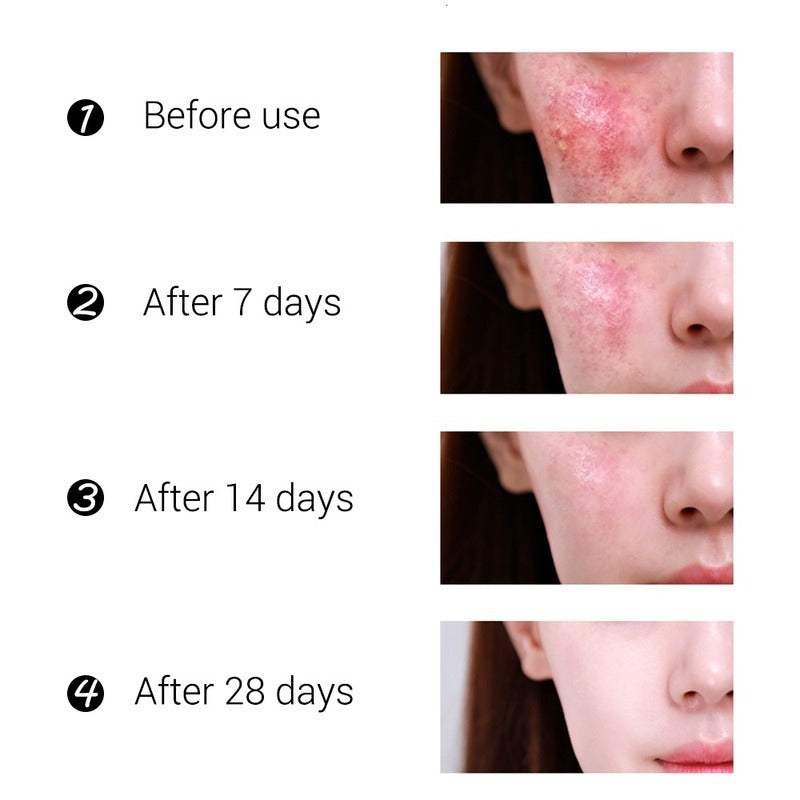 Acne Cream 30ml Is Easy To Use And Effective